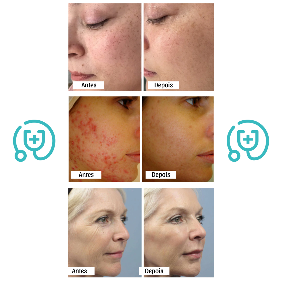 Máscara Facial de Terapia de Luz Vermelha LED