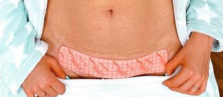 Apósito para cesárea aplicado sobre la incisión