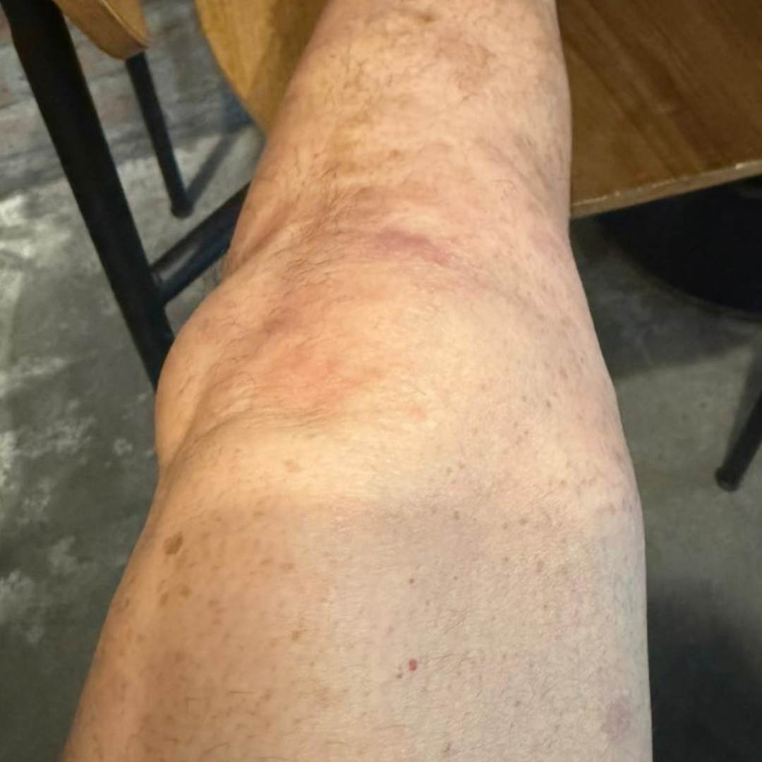 Después: piel más uniforme, sin escamas visibles