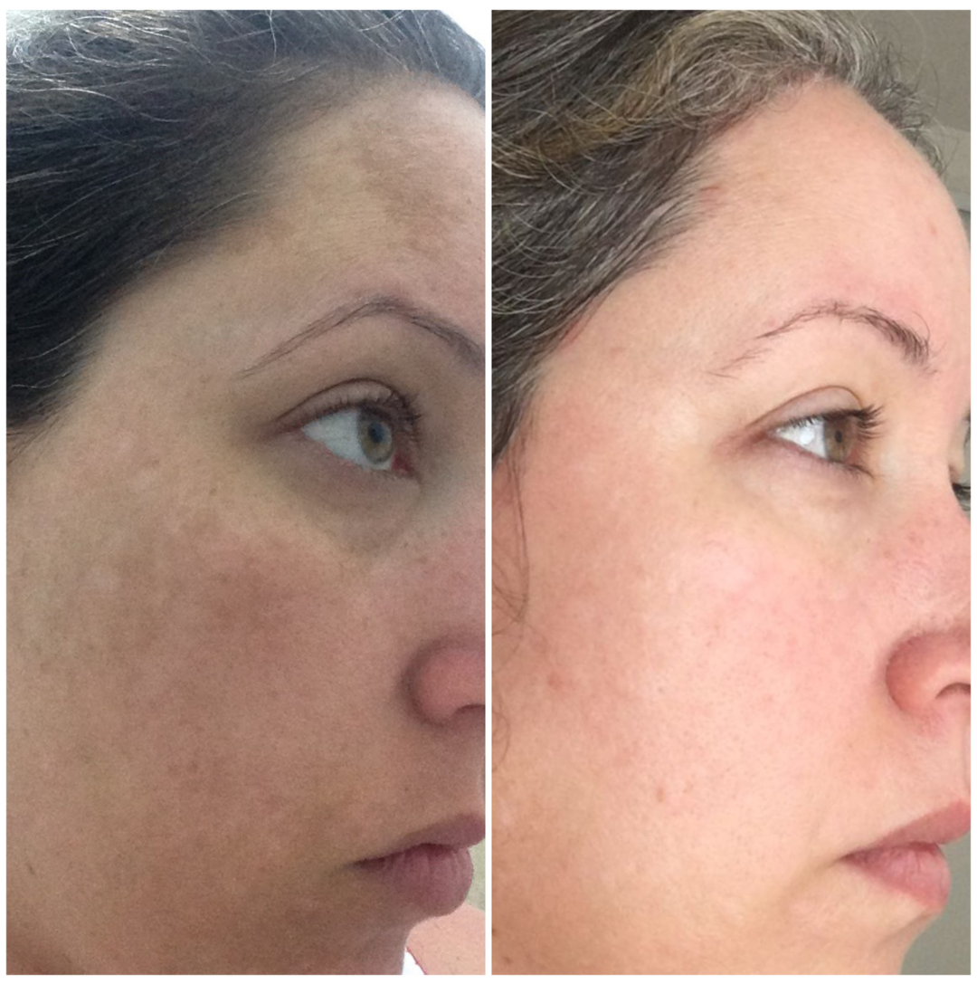 Resultado real — cliente 2 — Antiox Longevity Cream
