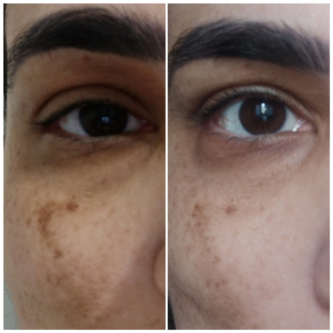 Resultado real — cliente 4 — Antiox Longevity Cream