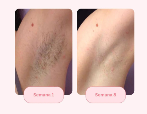 Comparativa de piel antes y después de usar LumissPro IPL