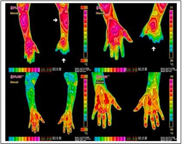 Imagem térmica mãos e braços