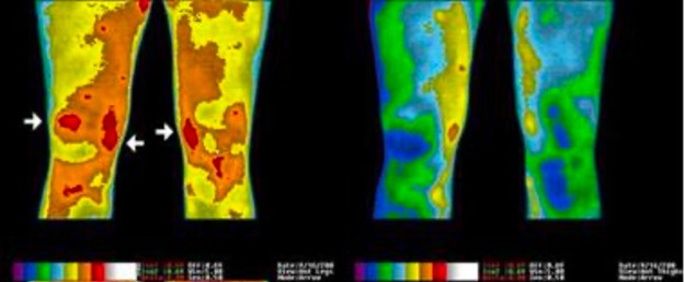 Imagem térmica joelhos