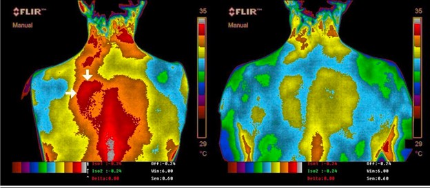 Imagem térmica costas e ombros