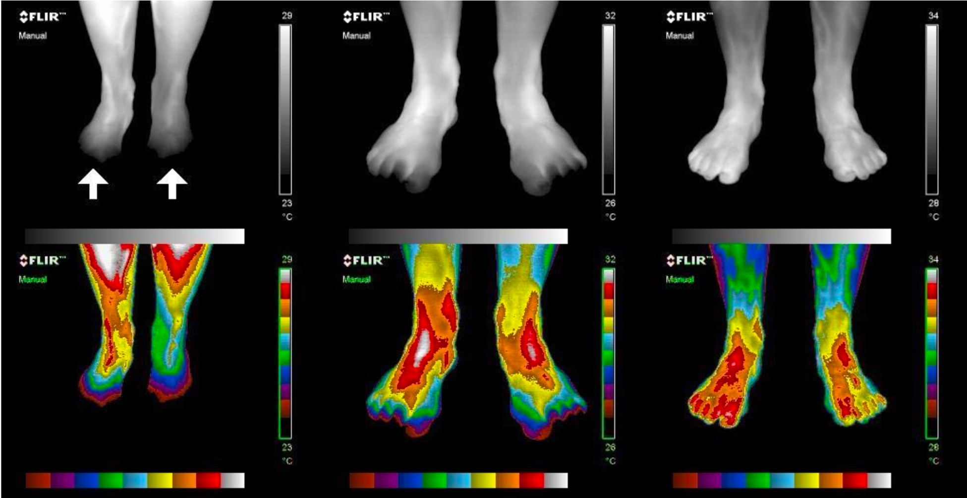 Imagem térmica circulação pés
