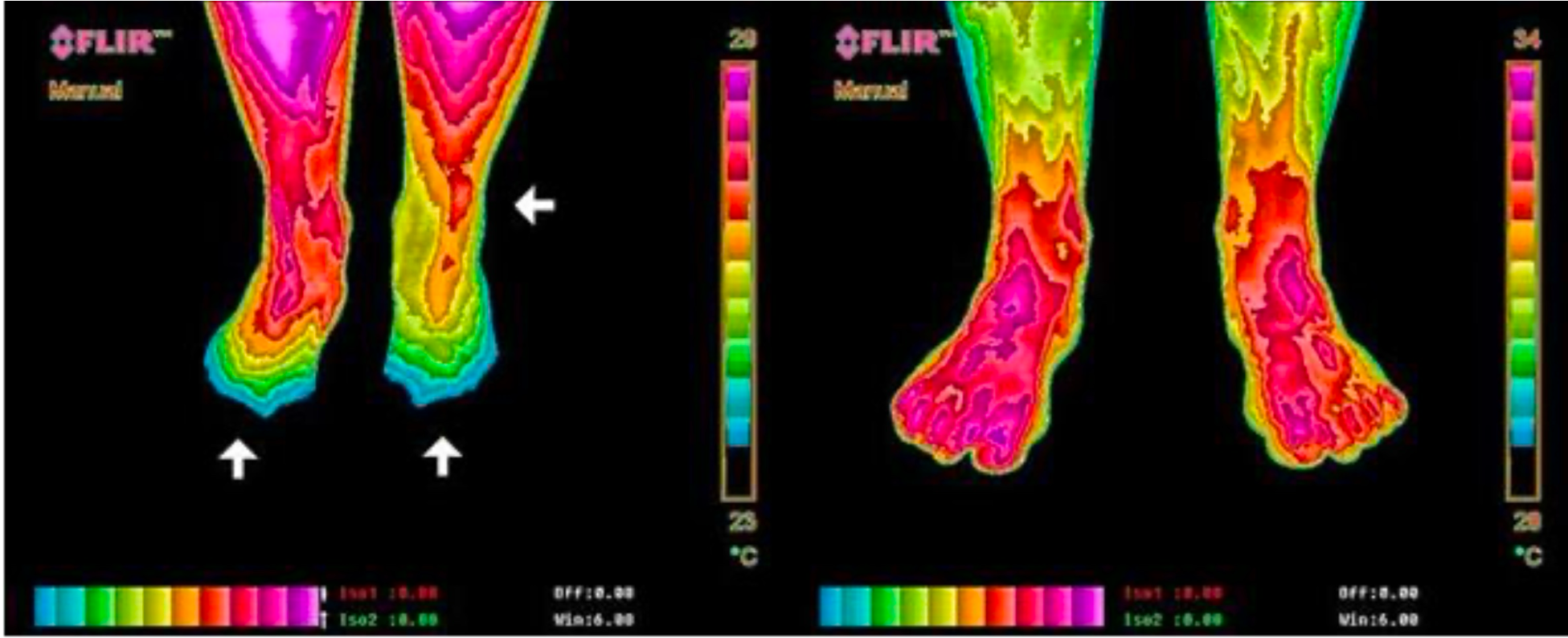 Imagem térmica pernas