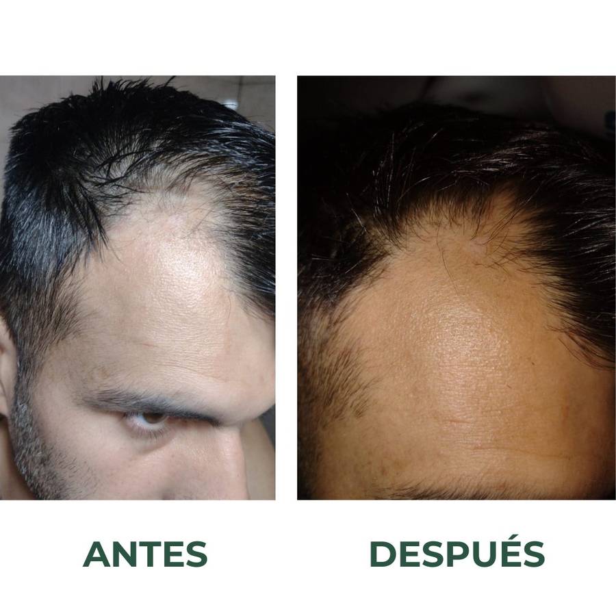 Before/after — entradas recuperadas con Skinfinity
