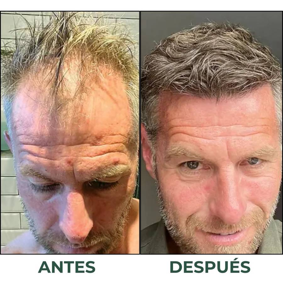 Before/after corona/vertex