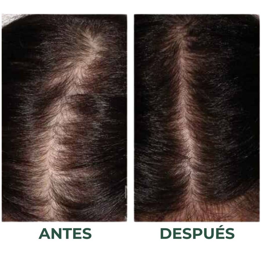 Before/after — Día 1 vs Día 81 con Skinfinity