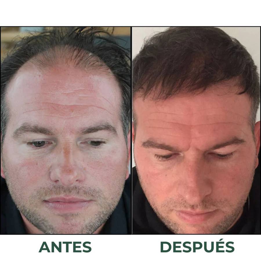 Before/after recuperación severa