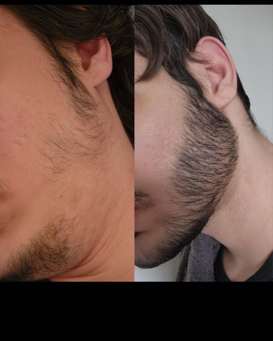 Barba antes y después — cobertura pareja tras 90 días con ANAGEN 5%