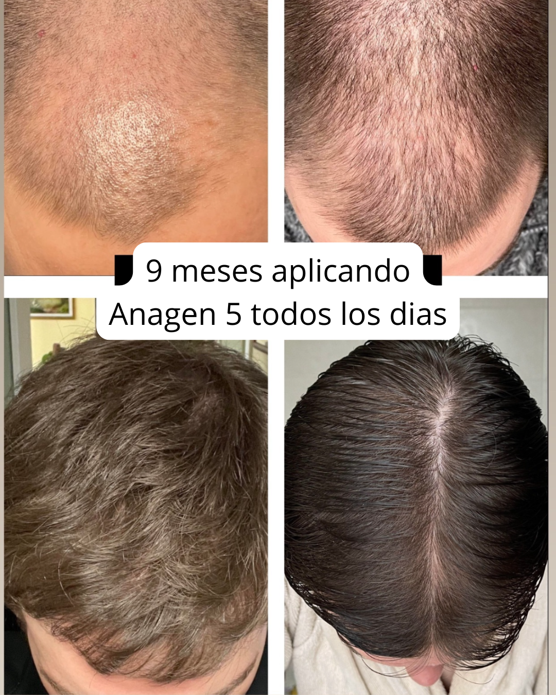 Evolución 9 meses — densidad y cobertura coronilla con ANAGEN 5%