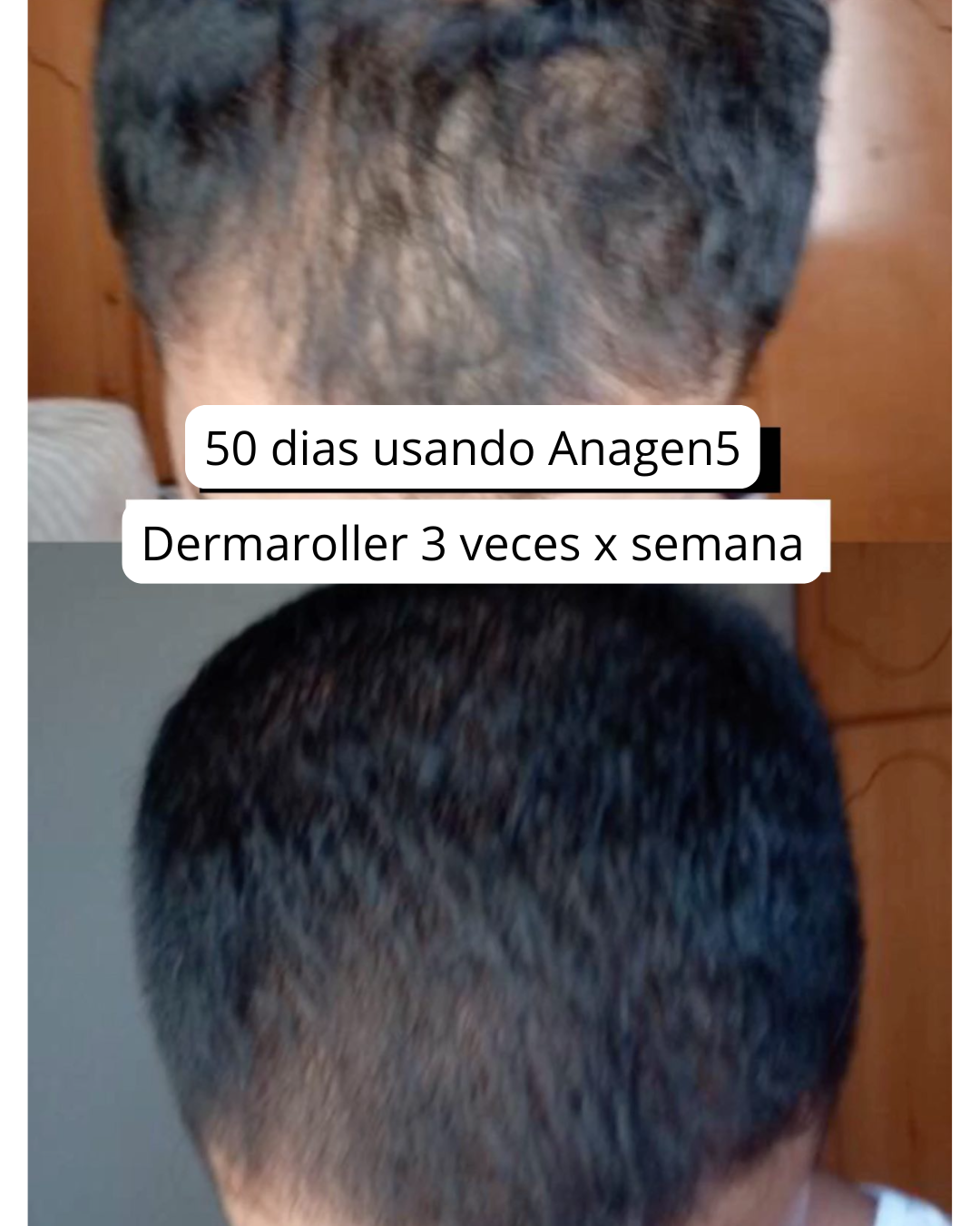 Antes y después 50 días — reducción de clareo con ANAGEN 5%
