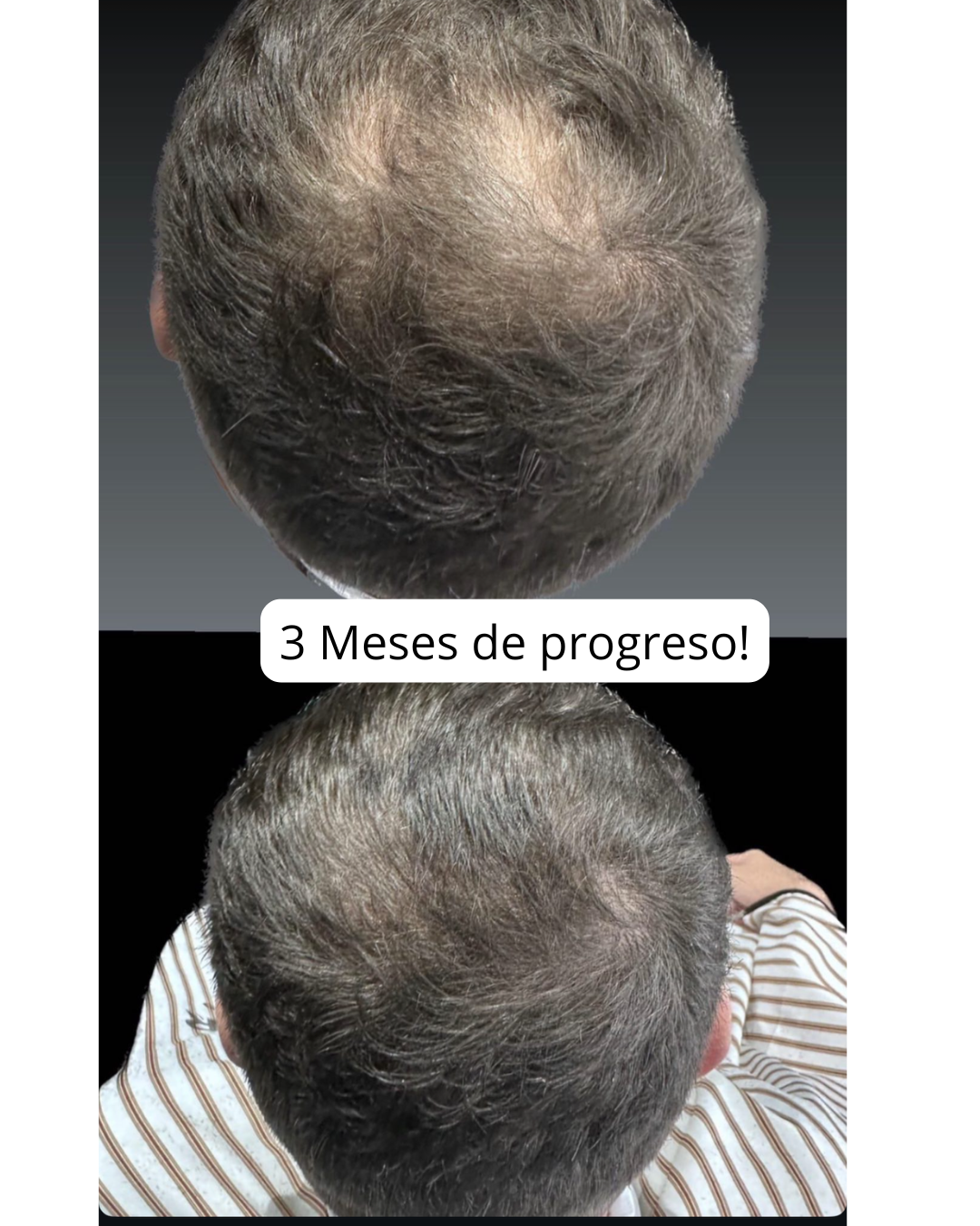 Tres meses de progreso coronilla — mayor densidad con ANAGEN 5%