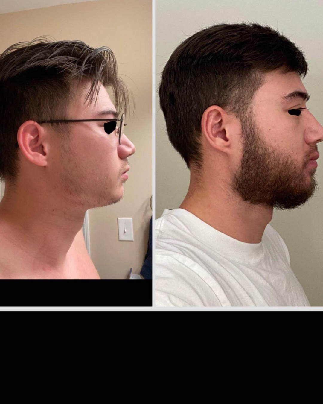 Barba antes/después — cobertura uniforme en 90 días