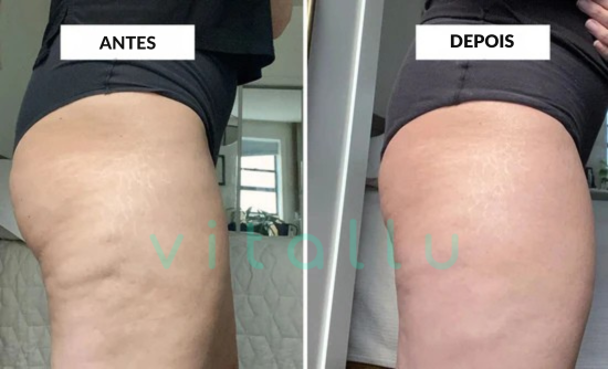 Massageador Anticelulite Portátil para Redução – CelluEase Pro 