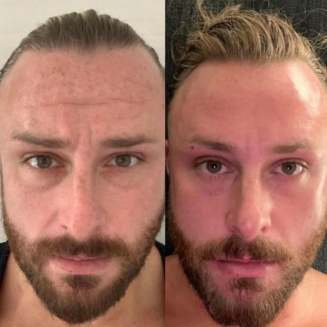 Antes y después Mister Care