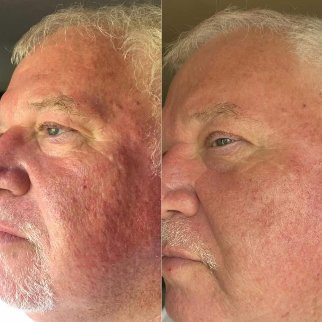 Antes y después Mister Care