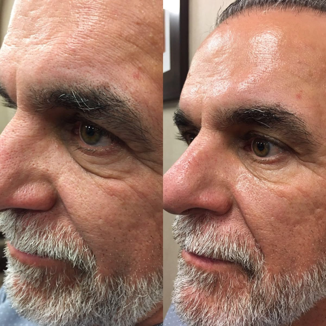 Antes y después Mister Care