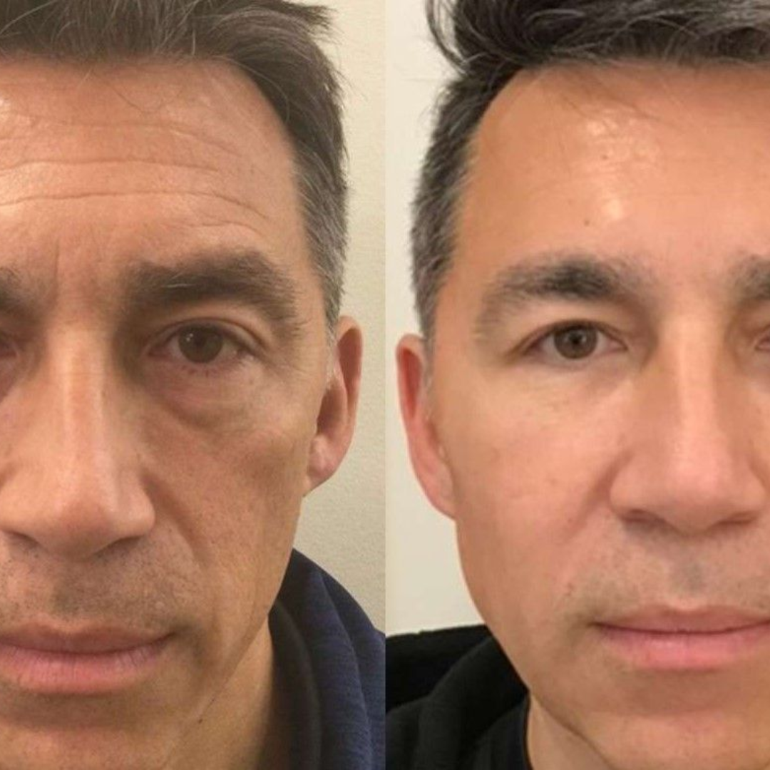 Antes y después Mister Care