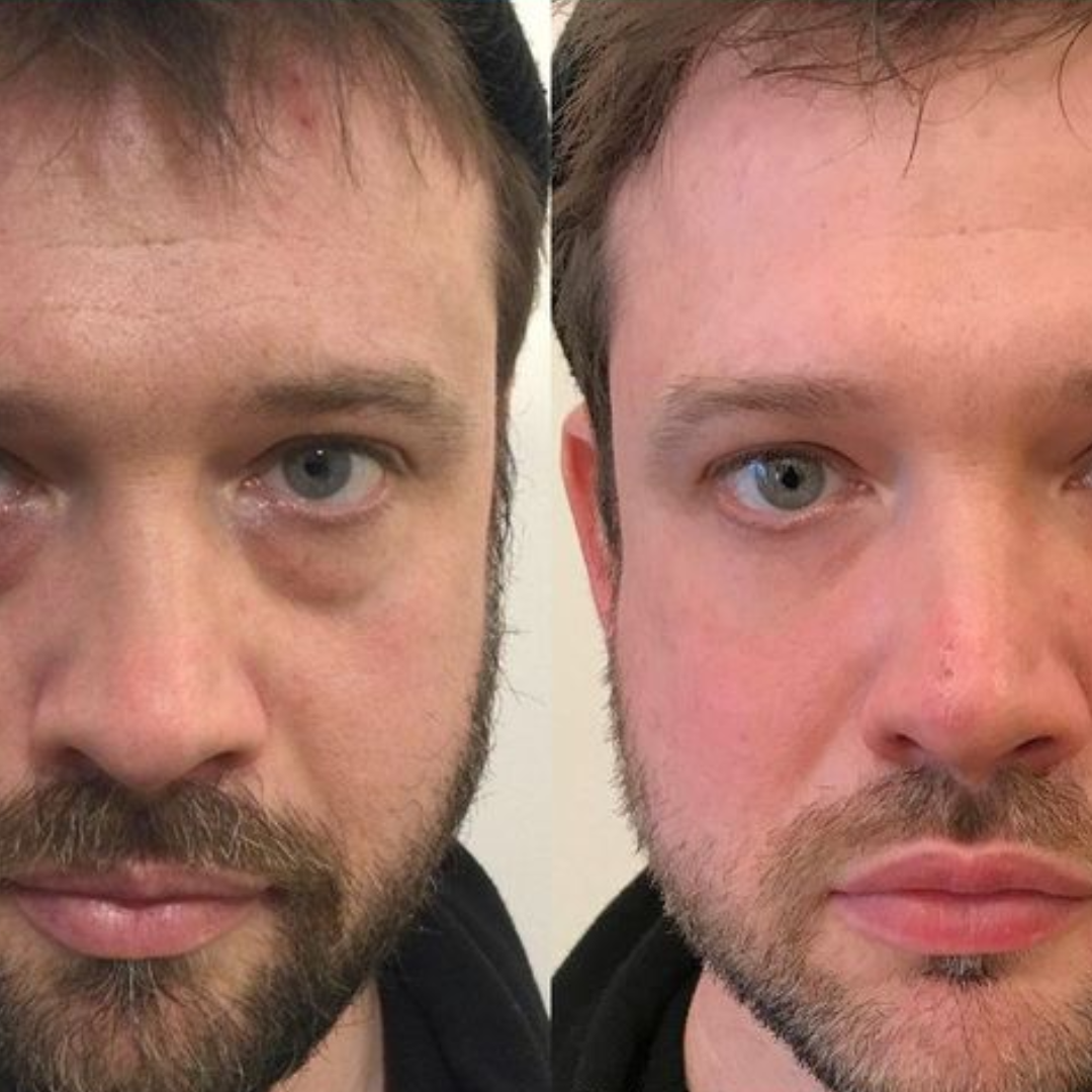 Antes y después Mister Care