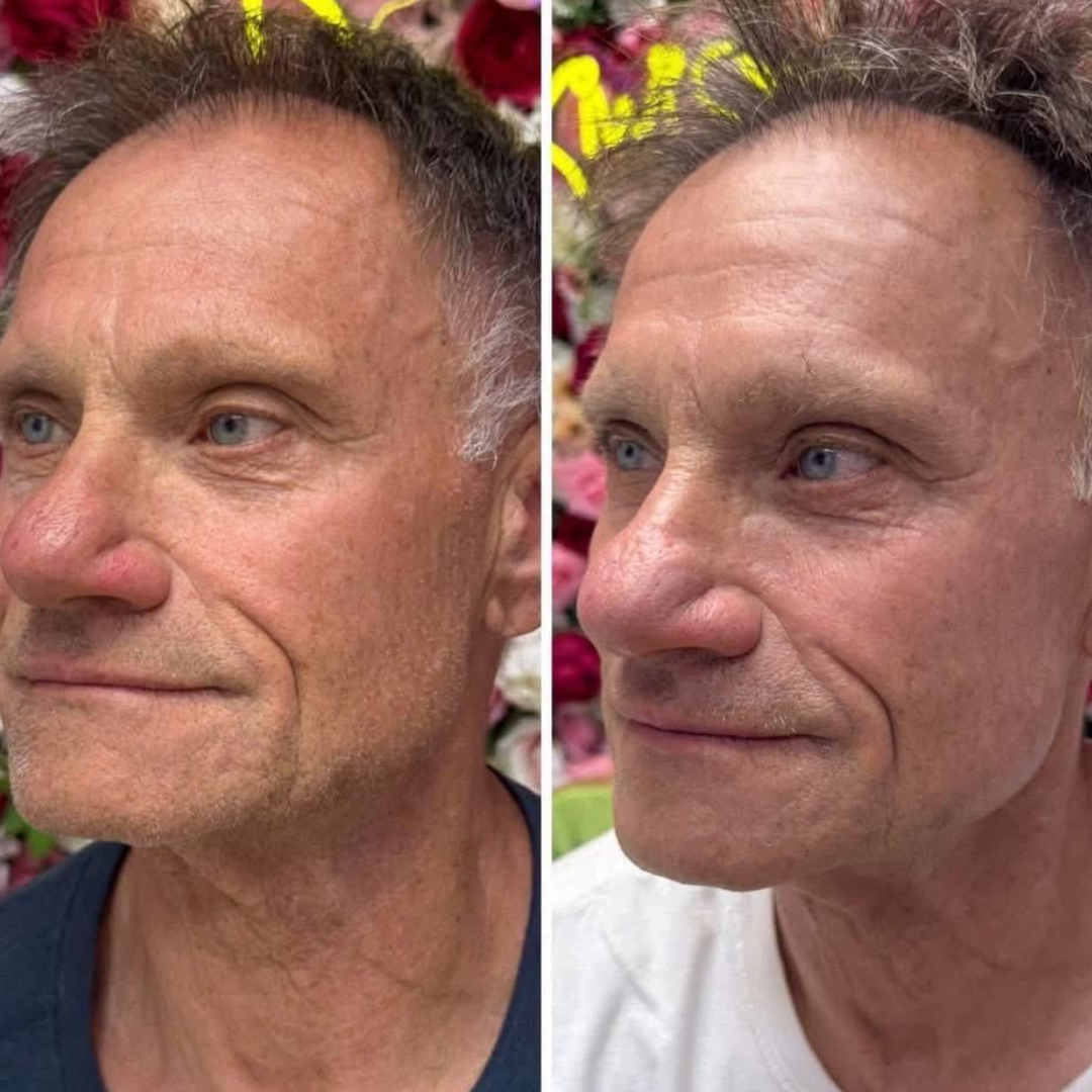 Antes y después Mister Care