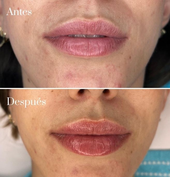 Acido hialuronico labios