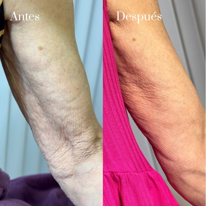 Bioestimulacion de brazos