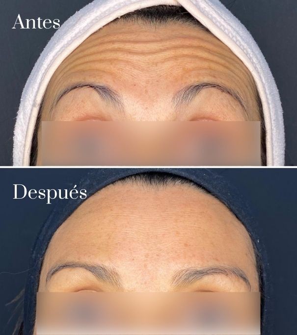Botox antes y despues