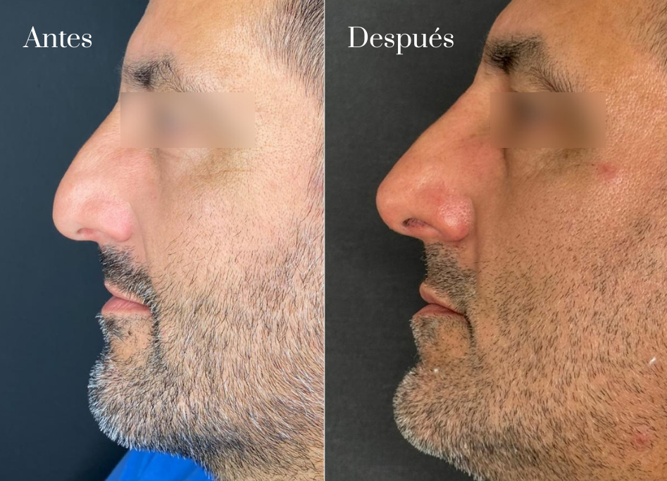 Rinomodelacion con Acido Hialuronico