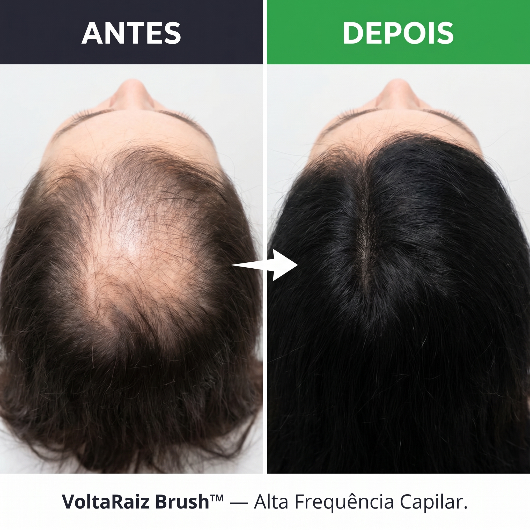 VoltaRaiz Brush &mdash; antes e depois calv&iacute;cie