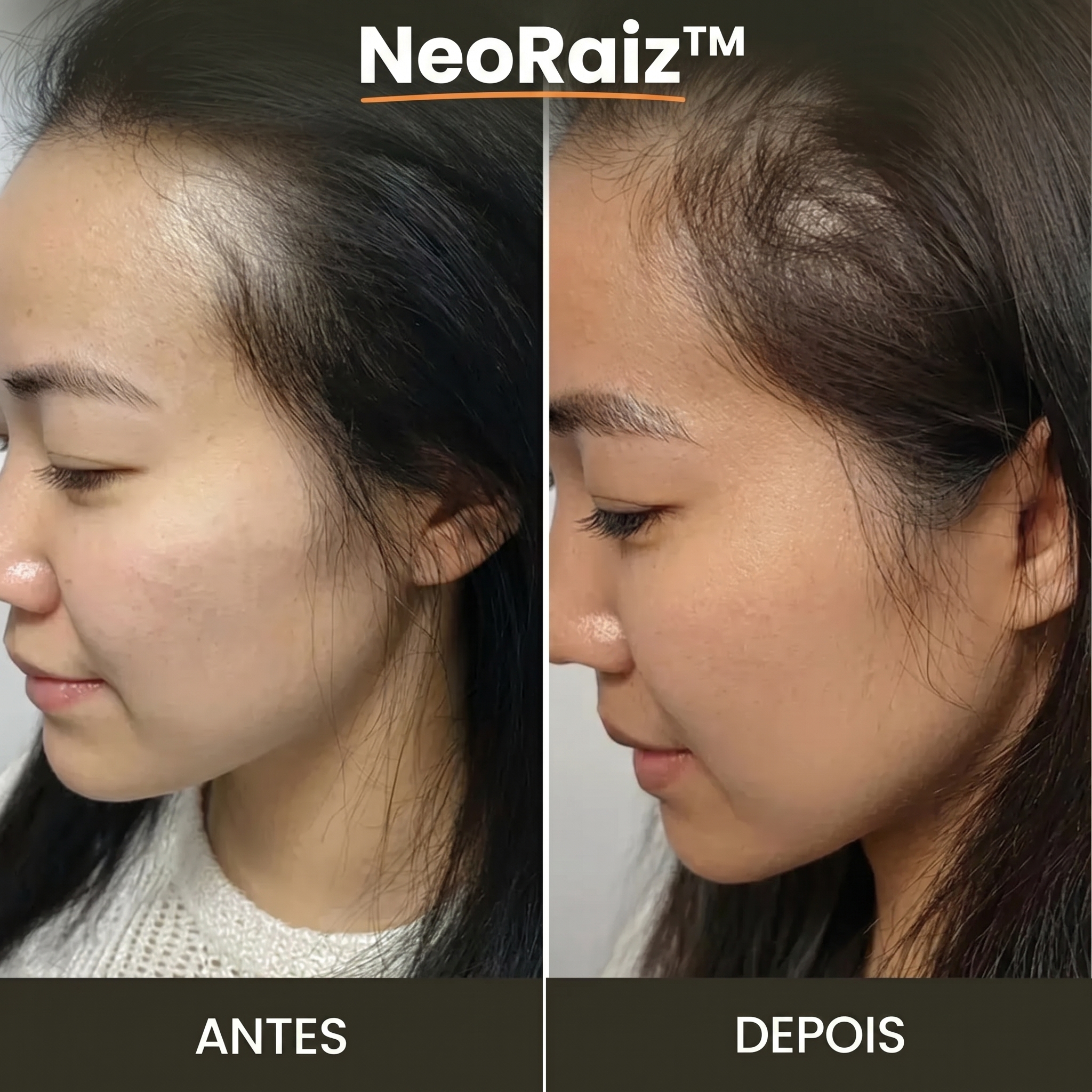 NeoRaiz resultado antes e depois crescimento capilar