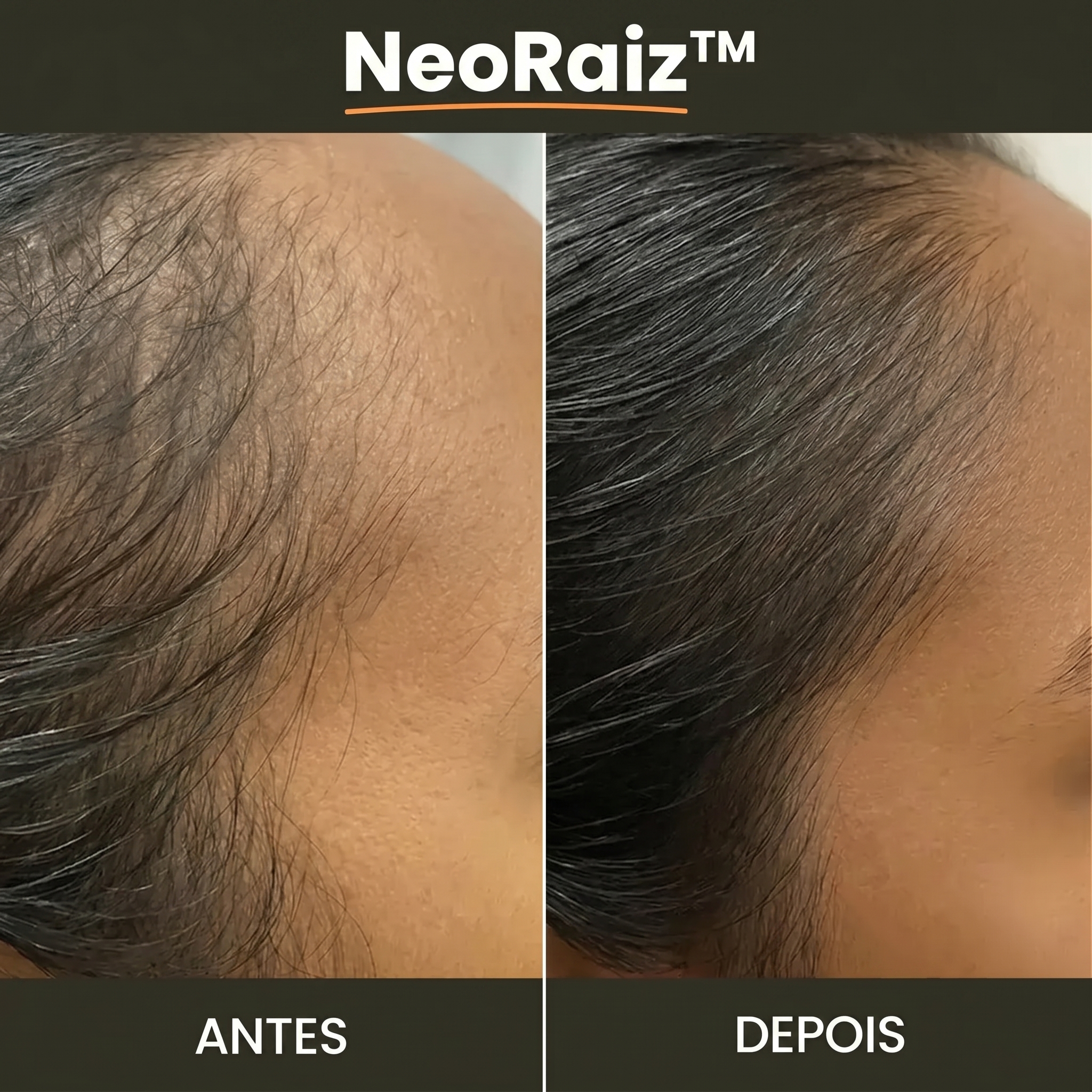 Resultado NeoRaiz &mdash; antes e depois queda capilar