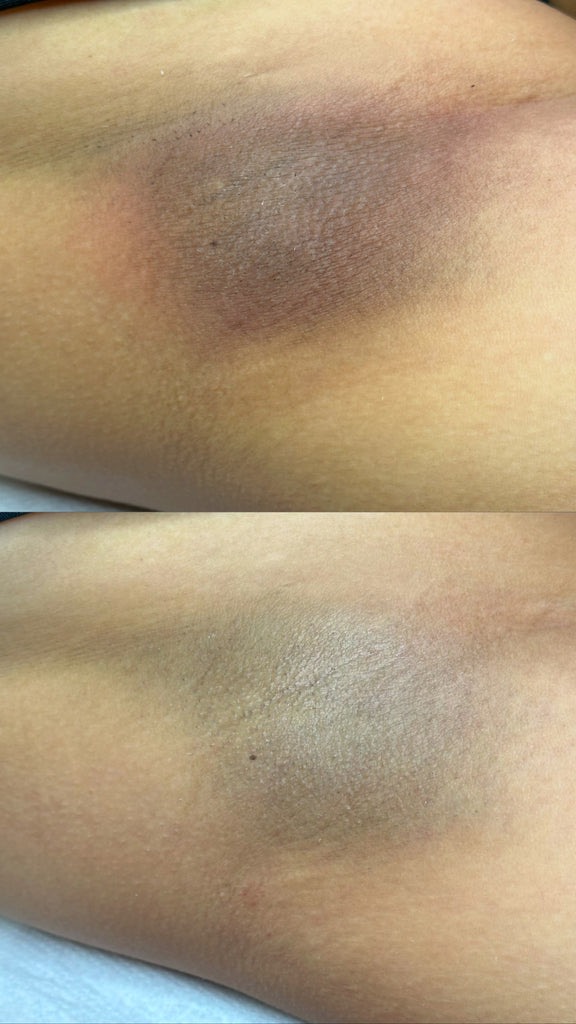 tratamiento aclarante de axilas