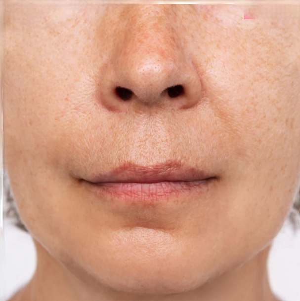Piel despu&eacute;s de usar el Kit Glow Coreano