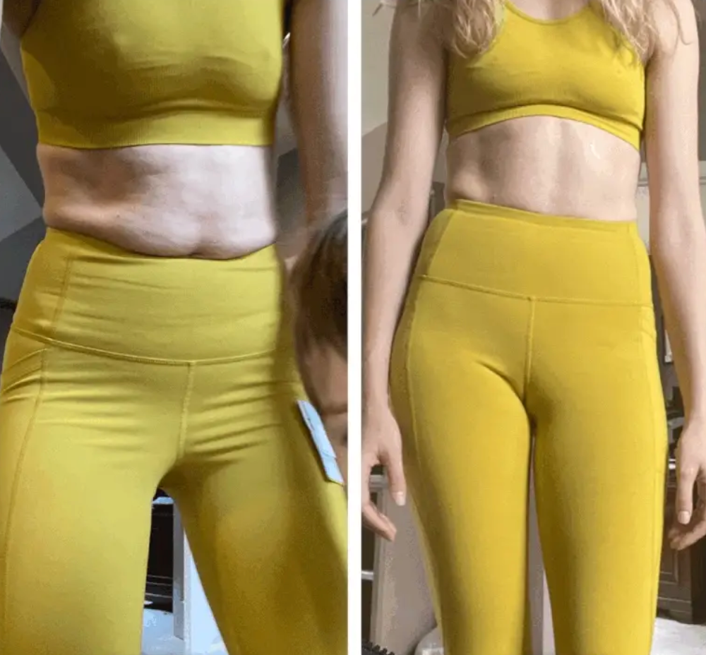 Testimonio de Vanesa Fern&aacute;ndez, antes y despu&eacute;s con DermaSculpt