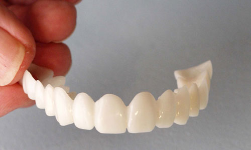 Pr&oacute;tesis dental Snap On Smile