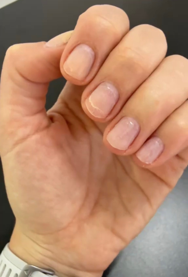 Uñas antes del tratamiento